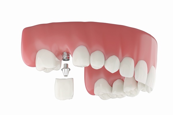 Single Tooth Implants: Addressing Tooth Loss With Long Term Solutions